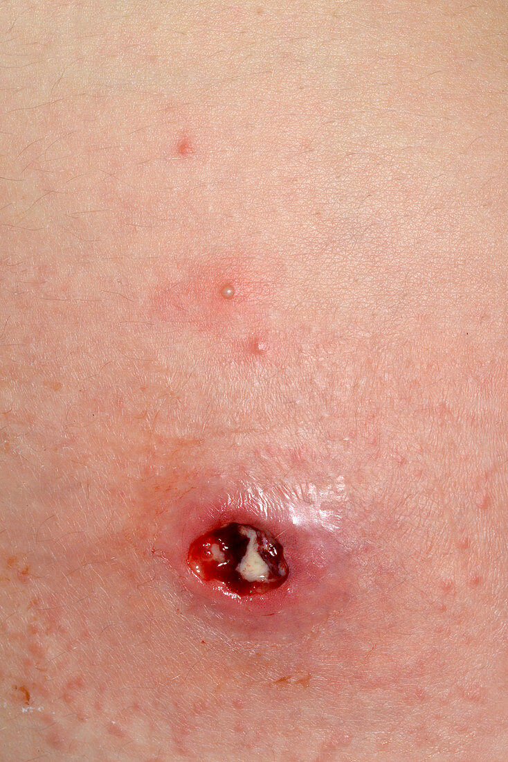 Ruptured abscess