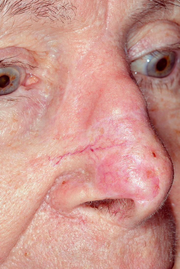 Scars from skin cancer removal