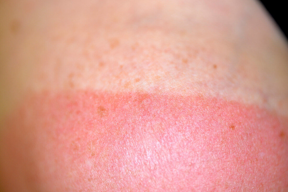 Sunburn