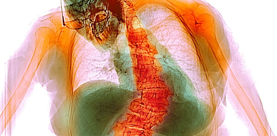 Spinal curvature,X-ray