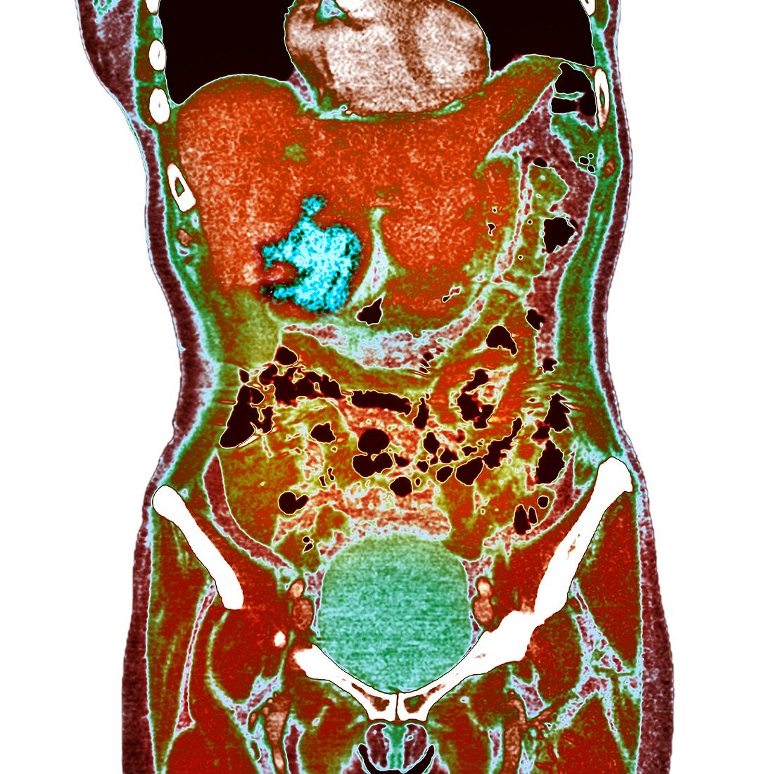 Liver cancer,X-ray