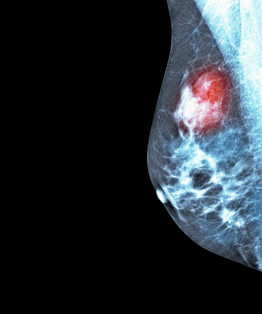 Breast cancer,X-ray