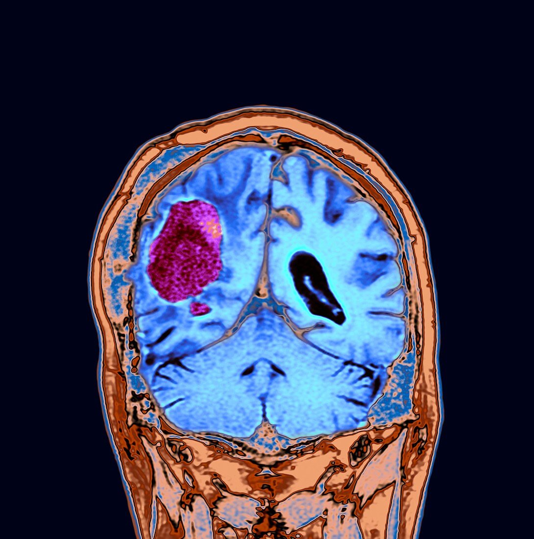 Brain cancer after surgery,MRI