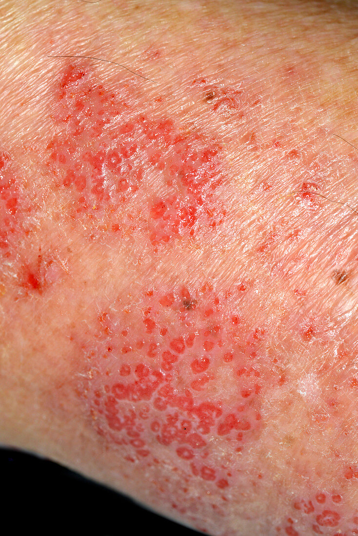 Dermatitis