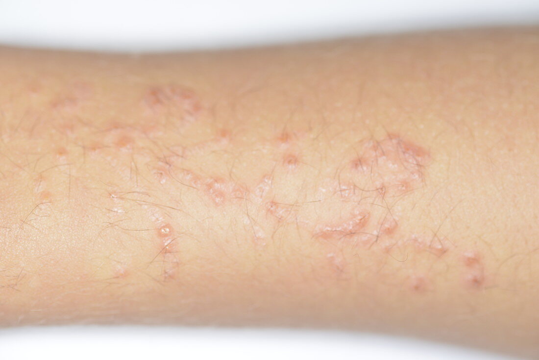 Allergic reaction to henna tattoo