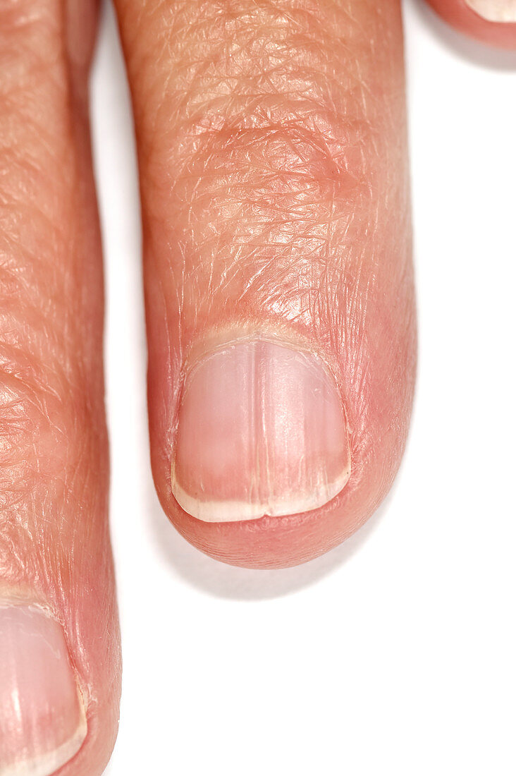 Ridged fingernail
