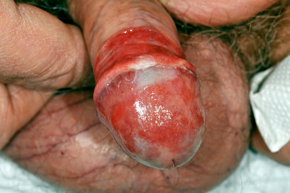 Zoon's balanitis of the penis