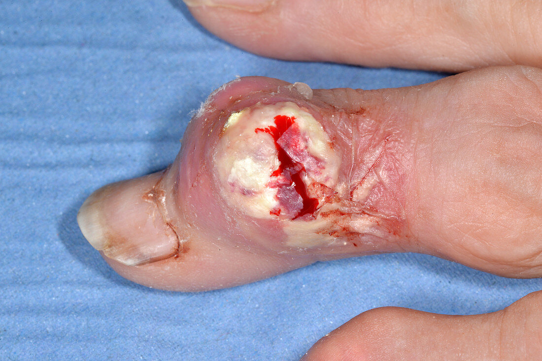 Gout of the finger