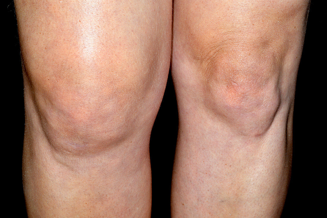 Swollen knee