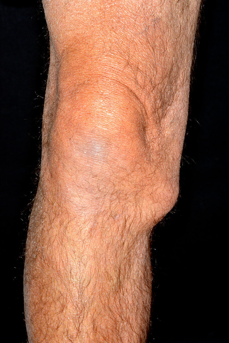 Torn knee ligament