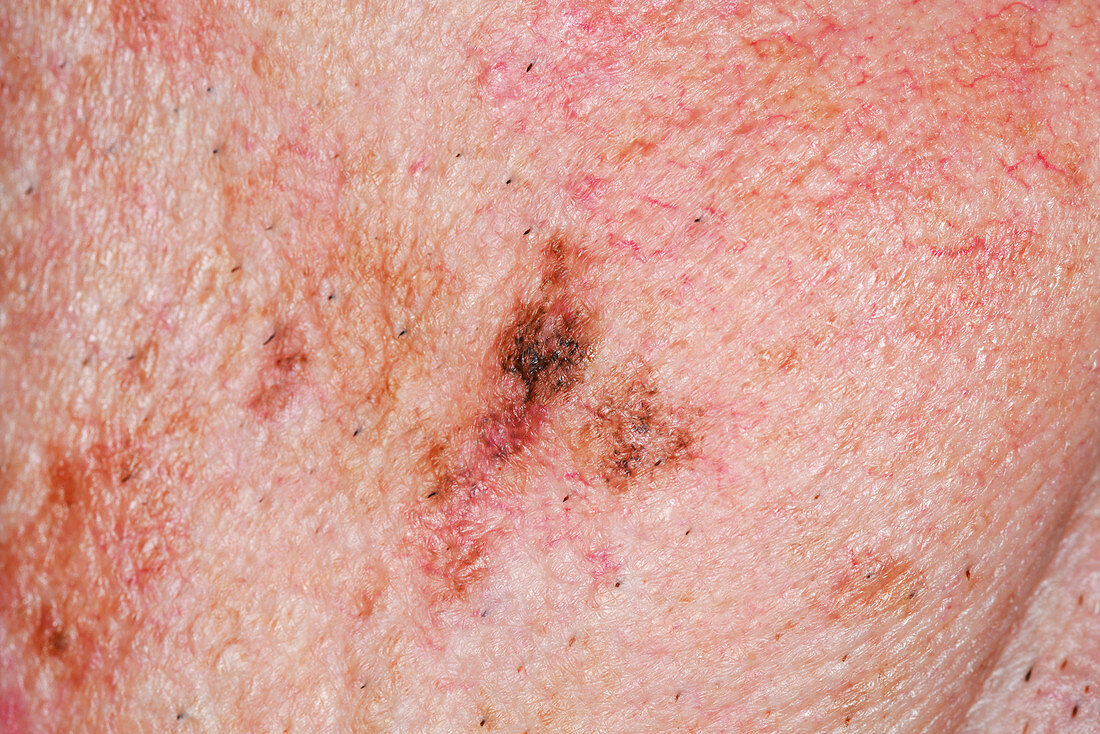 Precancerous skin lesion
