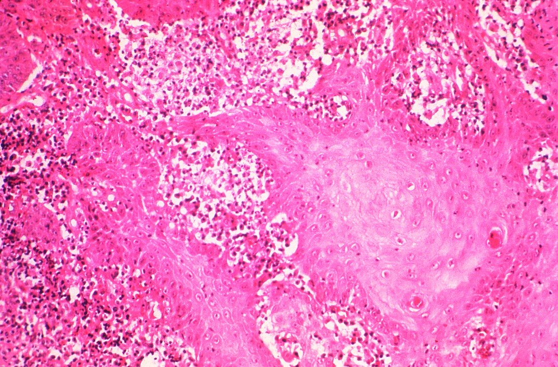 Granuloma inguinale,light micrograph