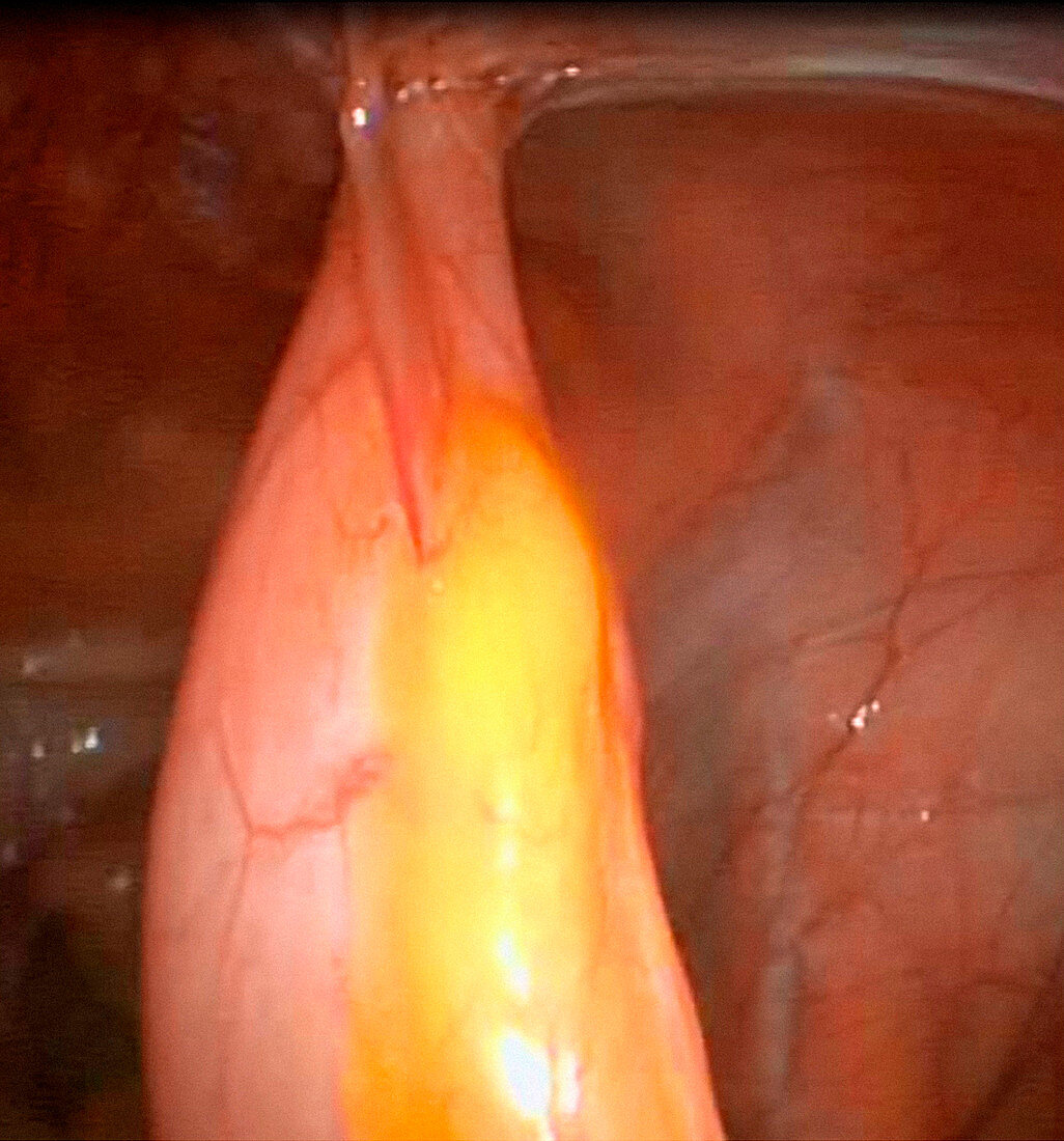 Intestinal adhesions,endoscope view
