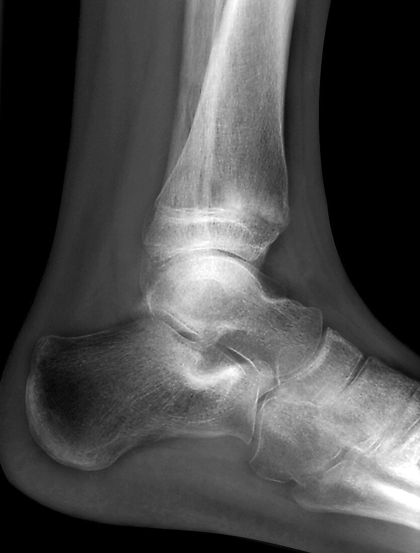 Leg fracture,X-ray