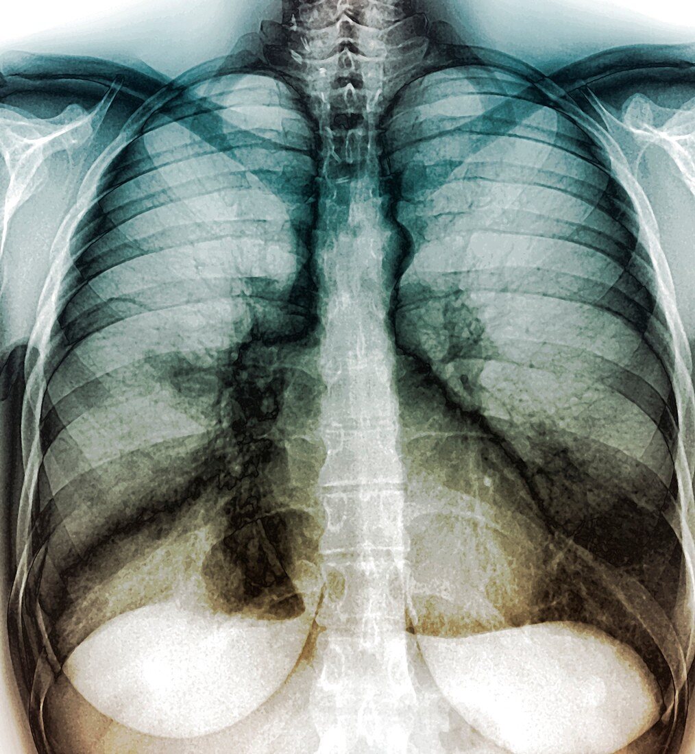 Chest infection,X-ray