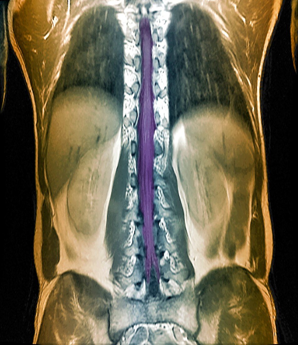 Normal spinal cord,MRI