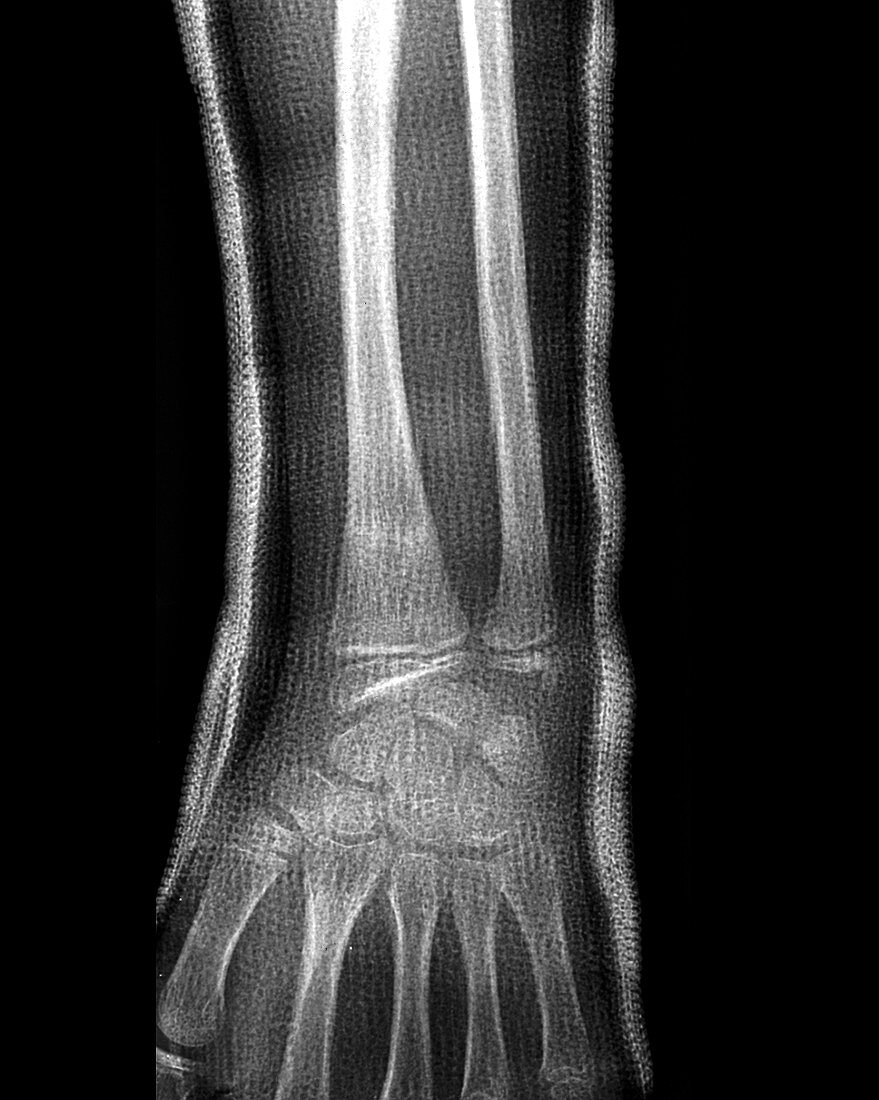 Wrist fracture,X-ray