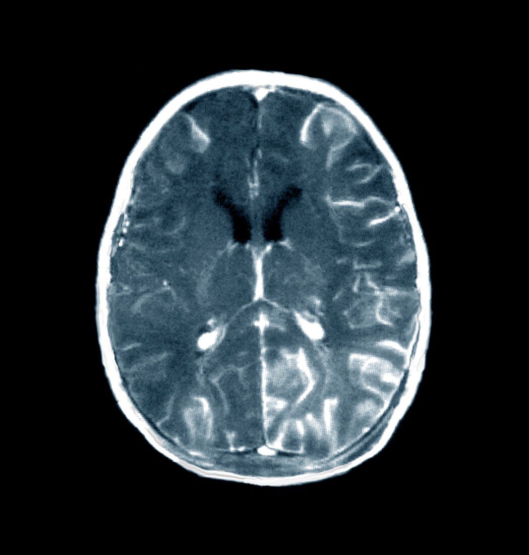 Brain in meningitis,CT scan