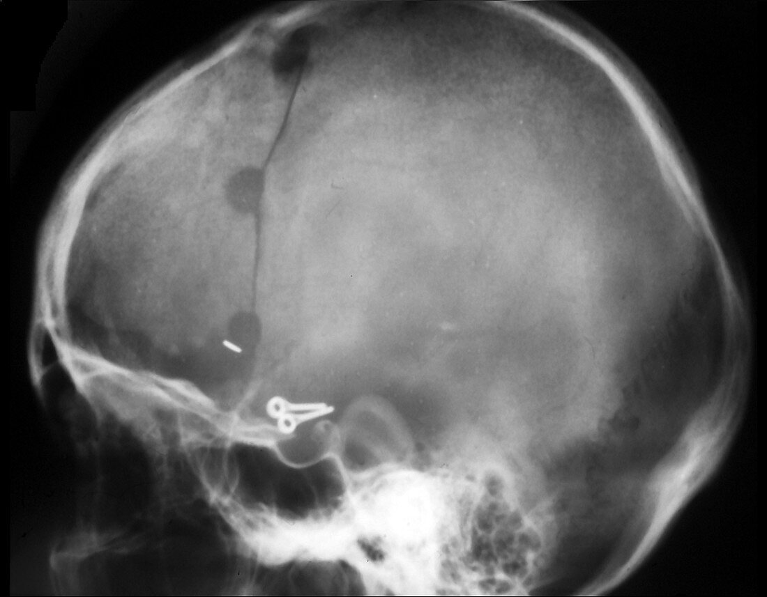 Brain haemorrhage,X-ray