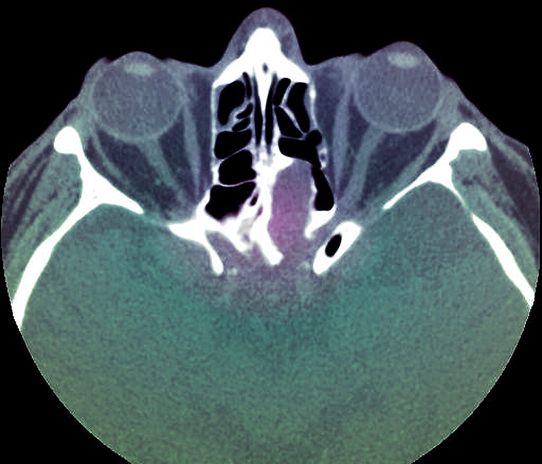 Dural tear following traffic accident,CT