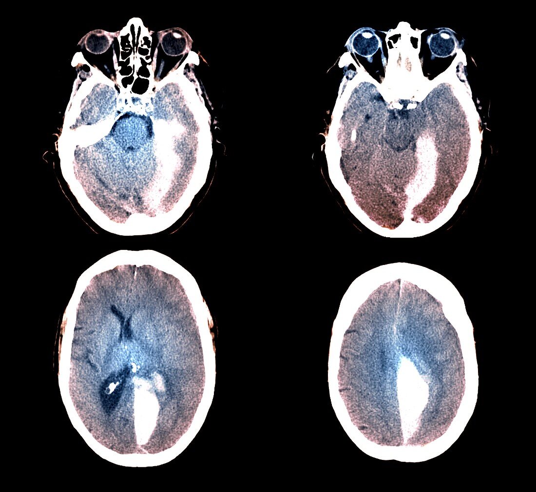 Brain haemorrhage following fall,X-ray