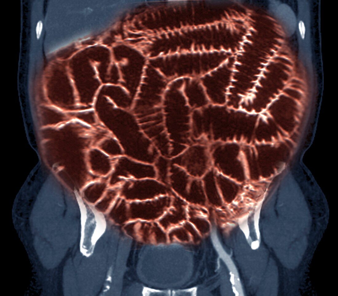 Normal intestines in obese patient,MRI