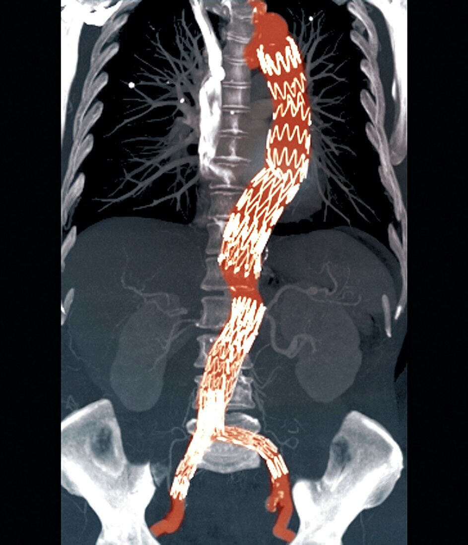 Abdominal aneurysm,CT scan