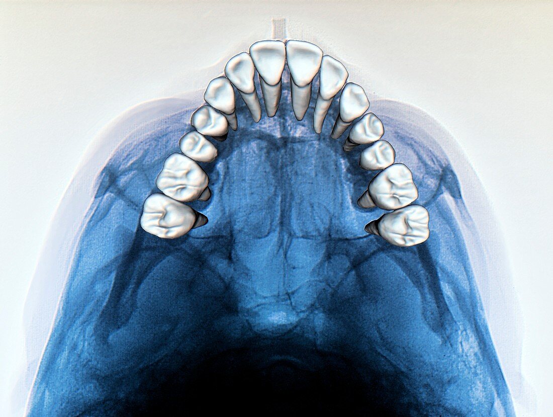 Dental arch in thumb sucking,X-ray