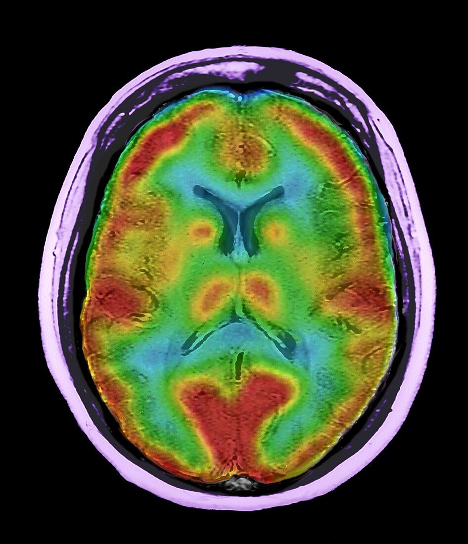 Normal brain blood flow,MRI and SPECT