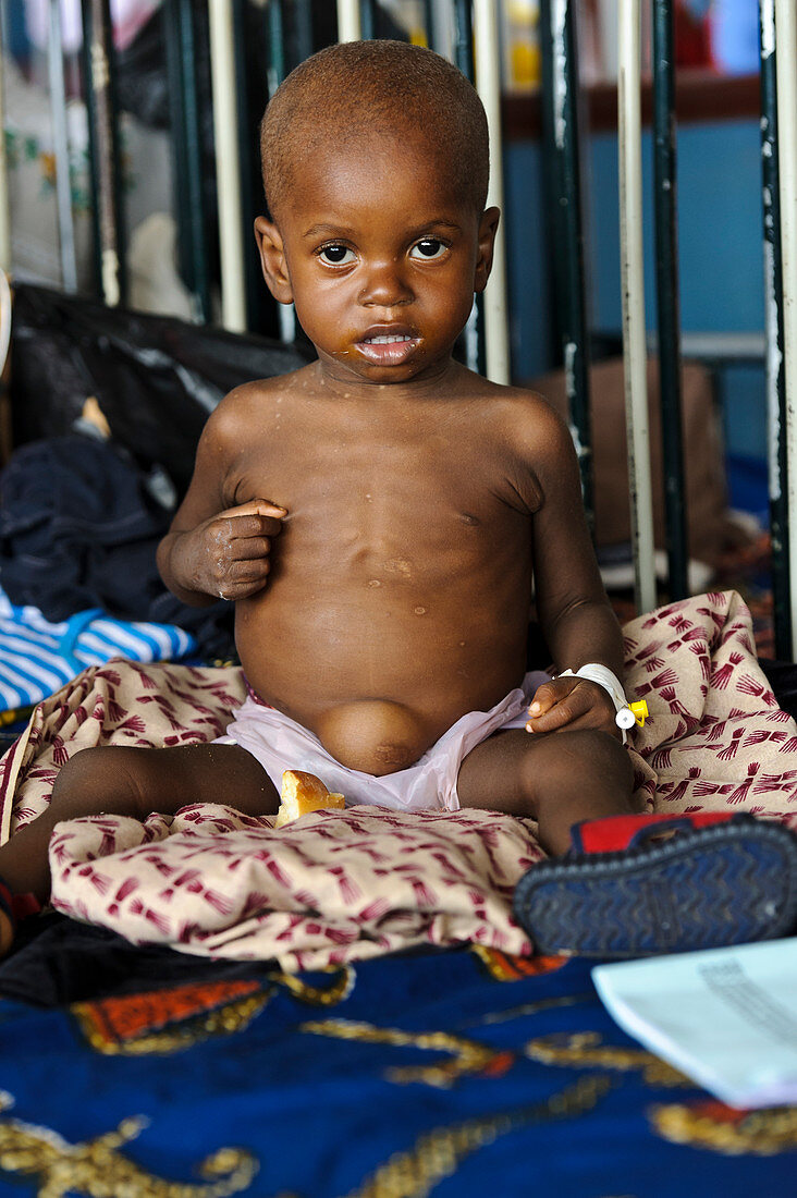 Malnourished child,Sierra Leone