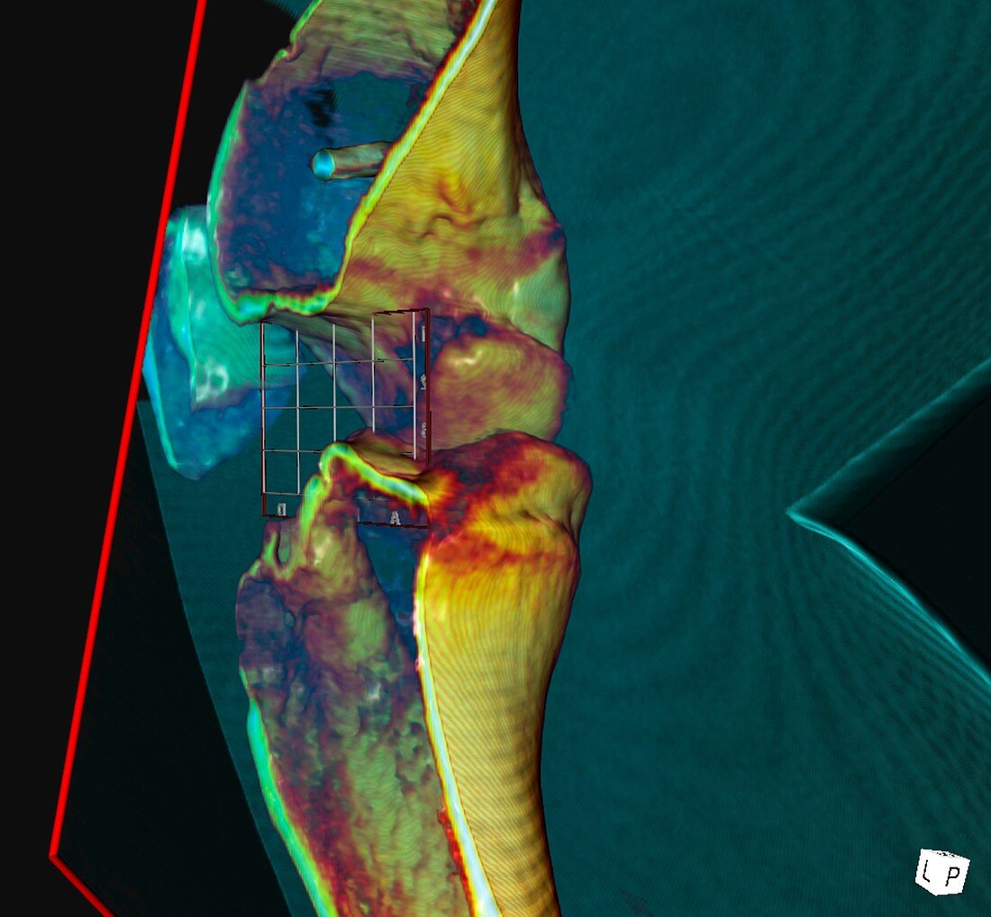 Knee ligament surgery,3D CT scan