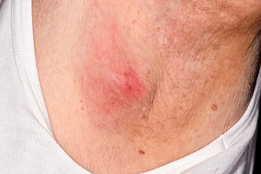 Infected sebaceous cyst