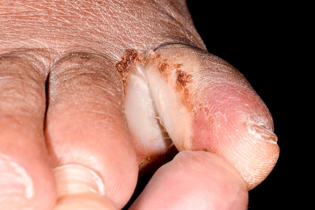 Athlete's foot toe infection in diabetes