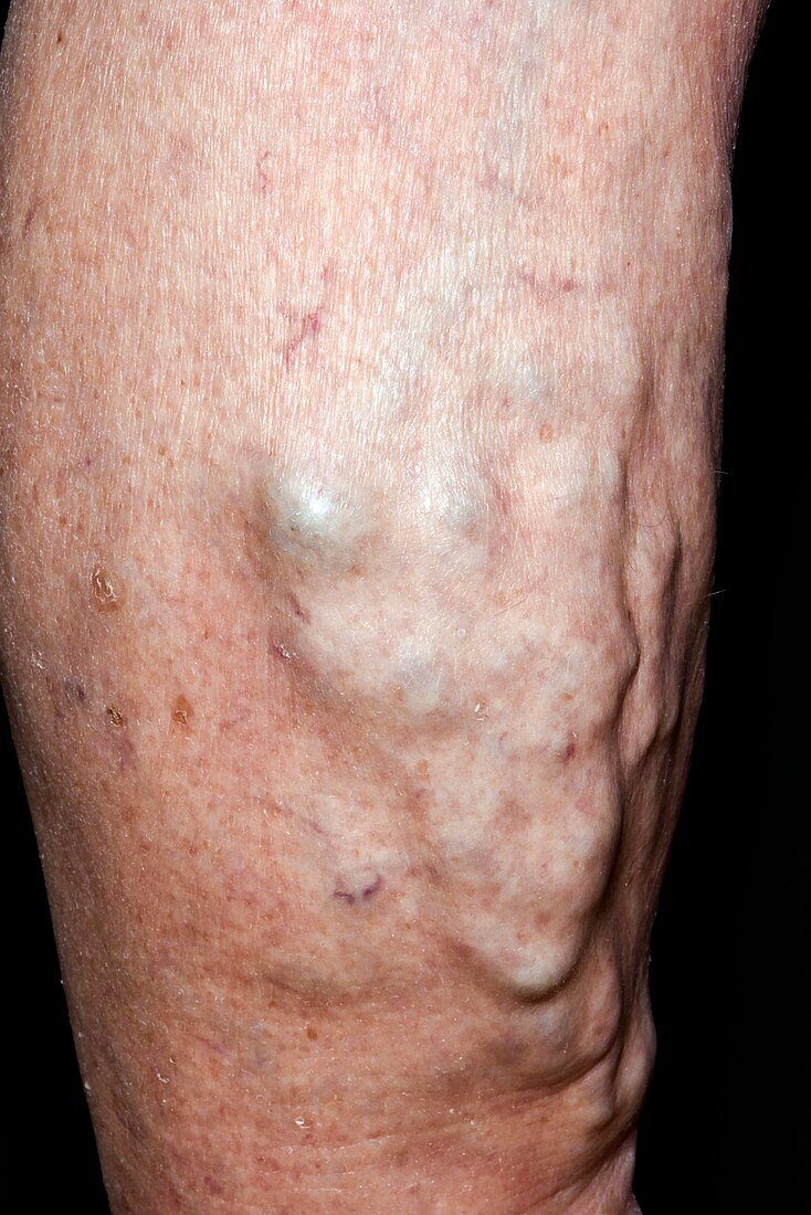 Varicose veins