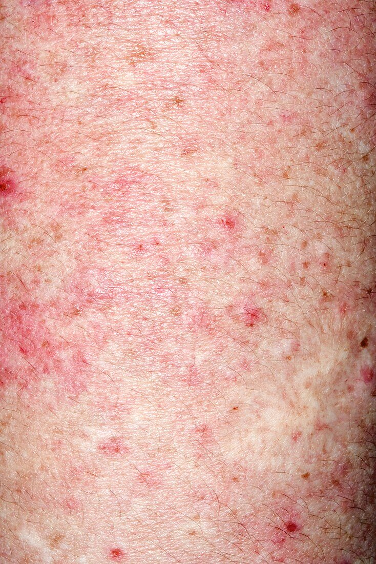 Rash after steroid use