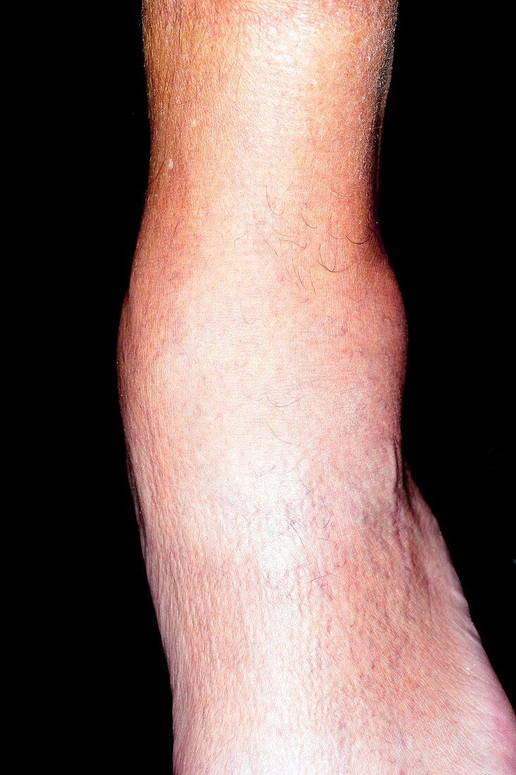 Gout in alcoholism