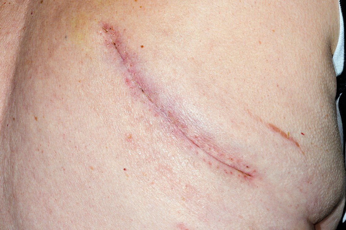 Lung cancer removal scar