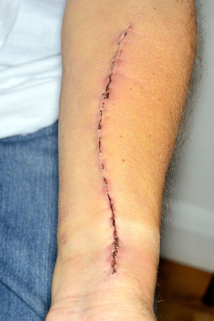 Heart bypass surgery scar
