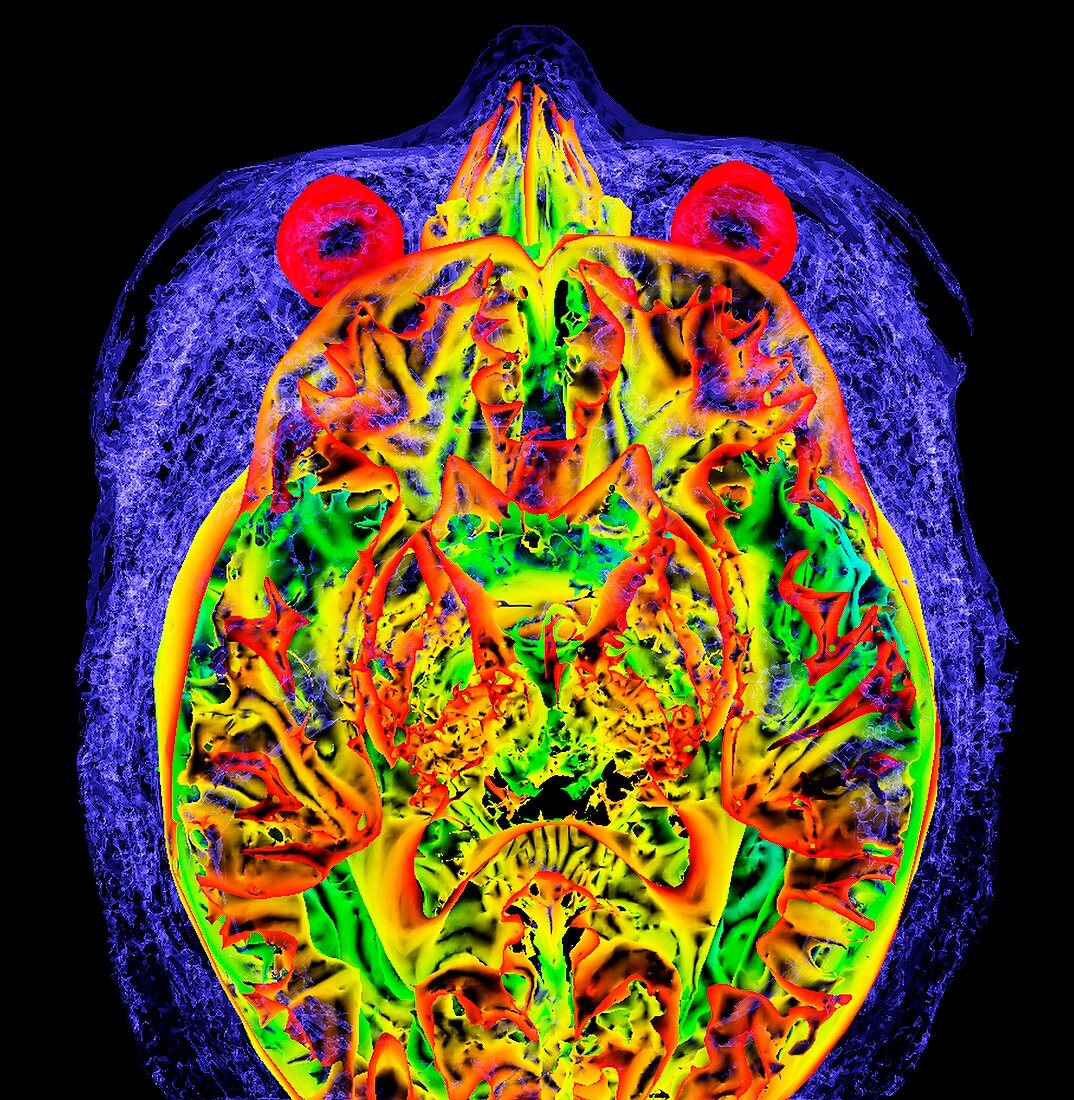Normal adult brain,3D MRI
