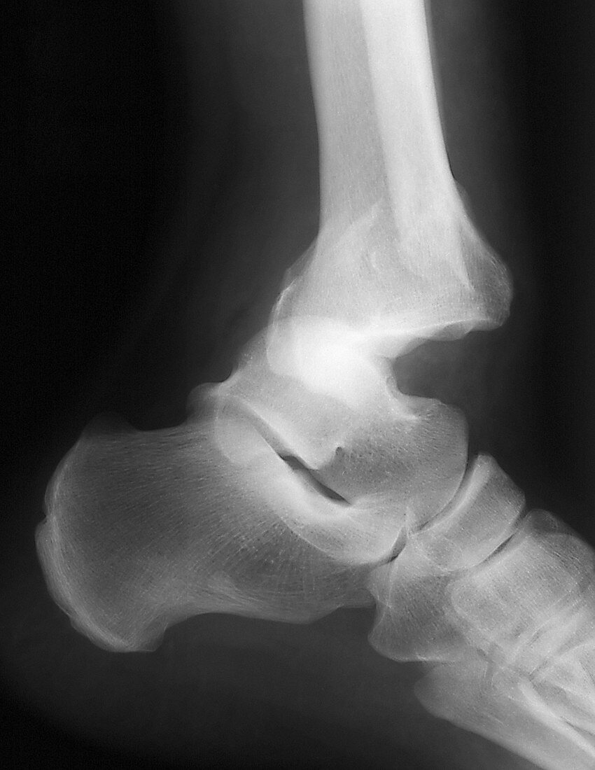 Fractured ankle,X-ray