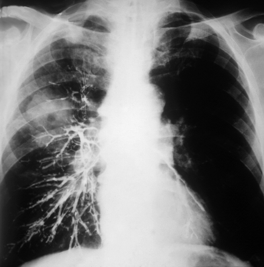 Lung tumour,X-ray