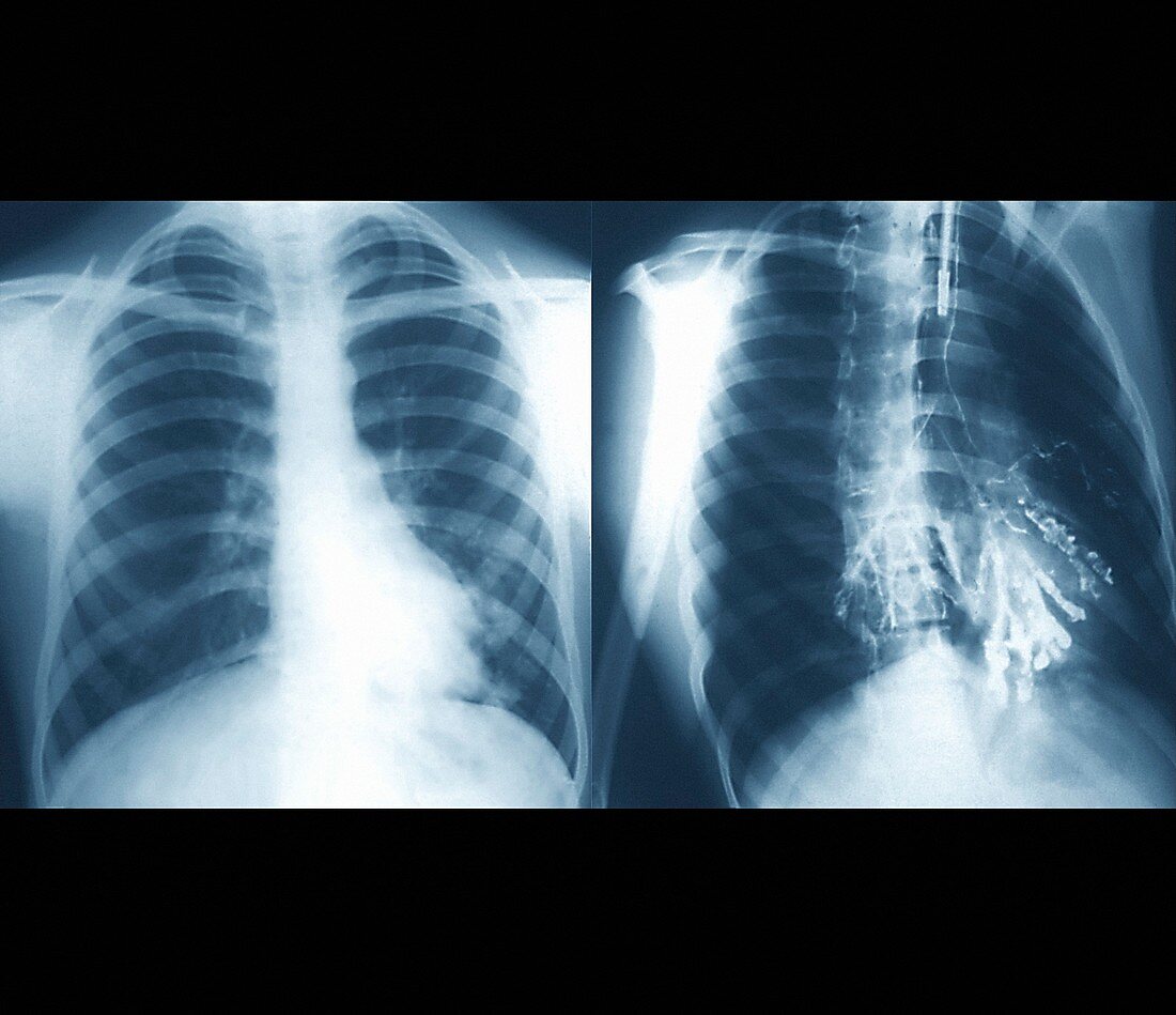 Bronchiectasis,X-ray