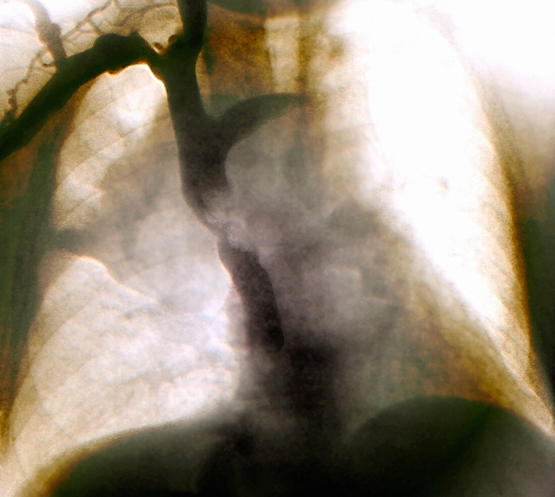 Metastatic lung cancer,X-ray