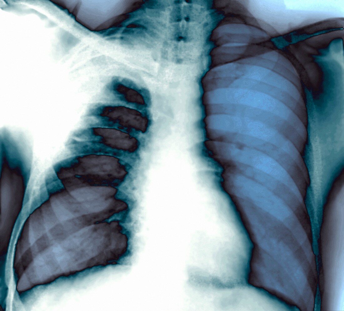 Pleurisy,X-ray