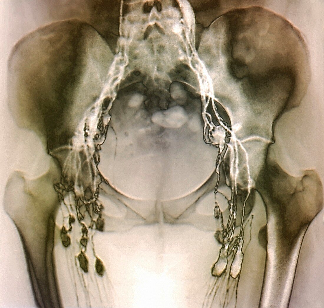 Normal pelvic lymphatic system,X-ray