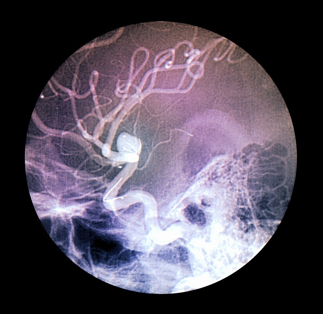 Brain aneurysm,X-ray