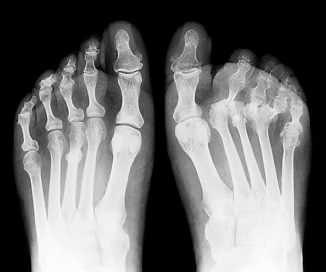 Rheumatoid arthritis of the feet,X-ray