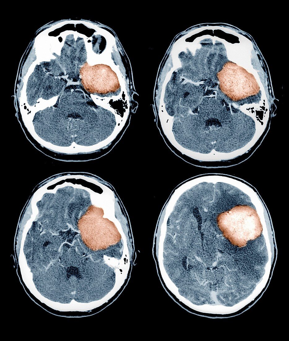 Brain tumour,CT scans