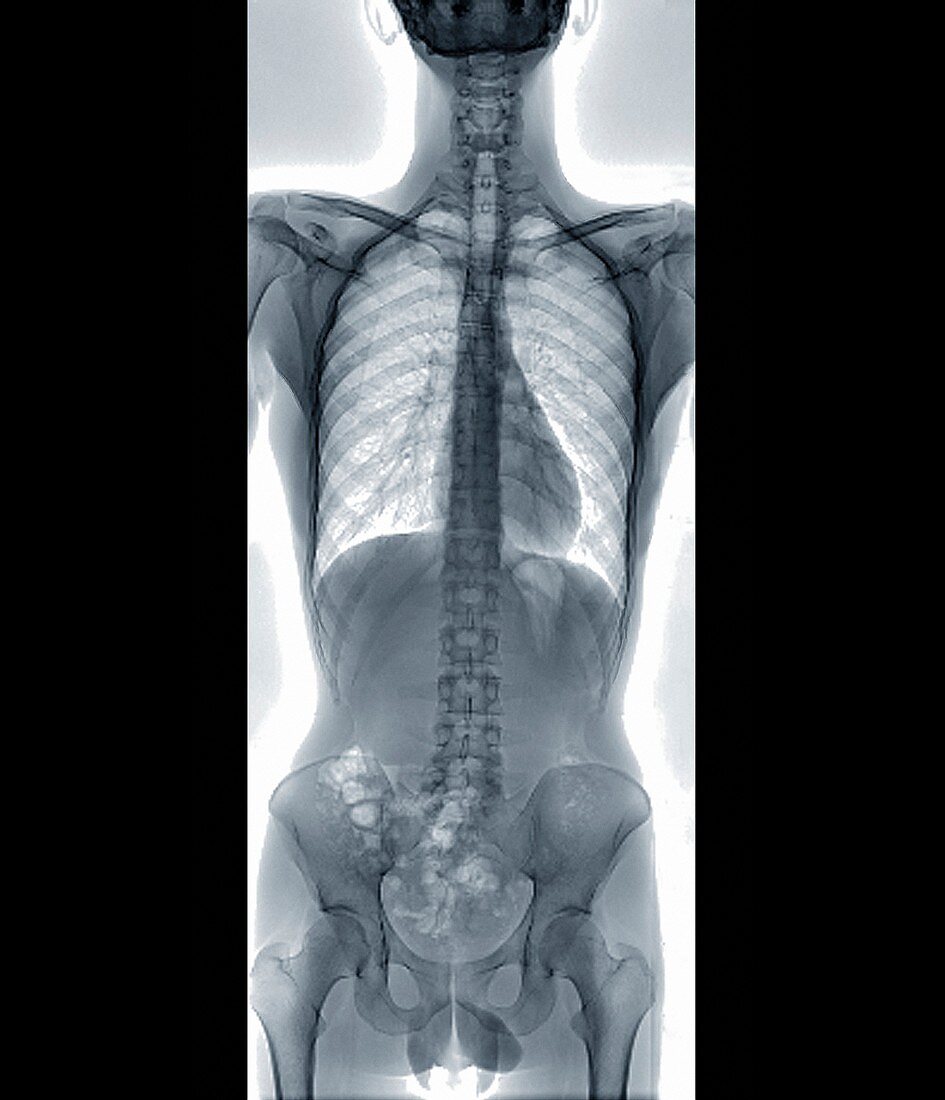 Normal spine,X-ray