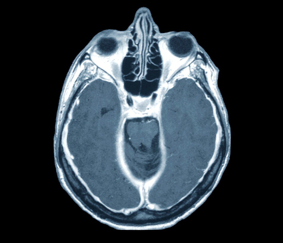 Pachymeningitis,MRI